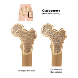 Abbildung normaler Knochen und Knochen mit Osteoporose, Copyright Fotolia